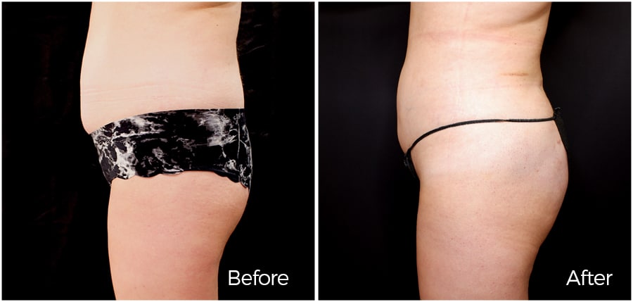 Dr. Epstein Liposuction and butt lift results