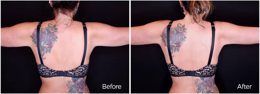 Dr. Epstein Liposuction results