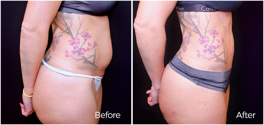 Dr. Epstein Liposuction results