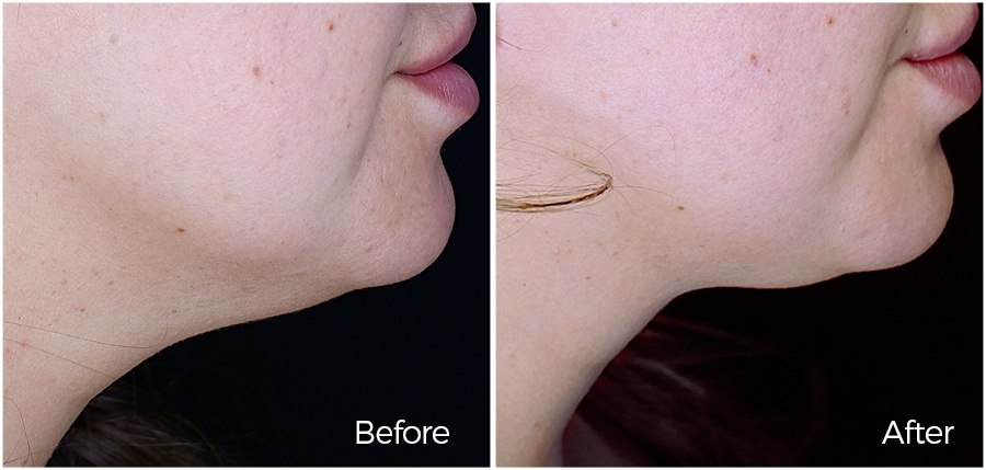 Dr. Epstein Neck Lift Results